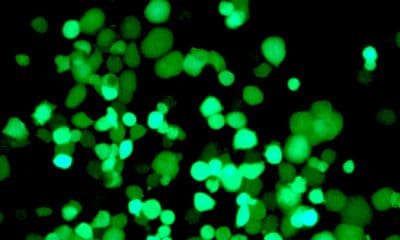 Células tumorales infectadas por el virus (fluorescente) cinco días después de la infecciónIdibaps e IRB Barcelona