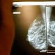 / Un médico examina unas mamografías. Eric Gaillard / Reuters