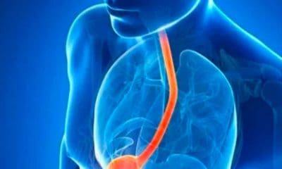 Reflujo, problema de salud que afecta a personas de la tercera edad