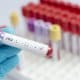 Eliminan la presencia del virus del VIH en cinco pacientes mediante trasplantes de células madre
